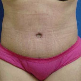 45-54 year old woman treated with Tummy Tuck after 3287813