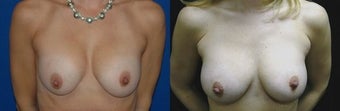 44 year old woman treated with Breast Augmentation before 2990388