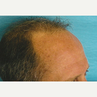 35-44 year old man treated with Hair Transplant before 3494902