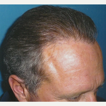35-44 year old man treated with Hair Transplant after 3494902