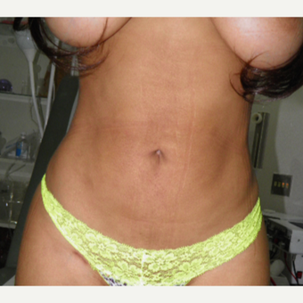 25-34 year old woman treated with Liposculpture after 3103890