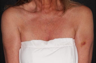 55-64 year old woman treated with Ultherapy for laxity of cleavage before 3226331