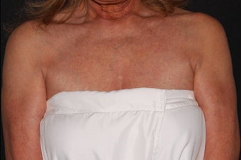55-64 year old woman treated with Ultherapy for laxity of cleavage after 3226331