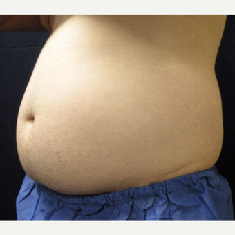 18-24 year old man treated with CoolSculpting before 3680176