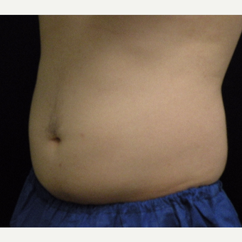 18-24 year old man treated with CoolSculpting after 3680176