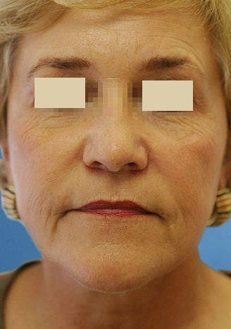 Artefill for NasoLabial Folds after 109217