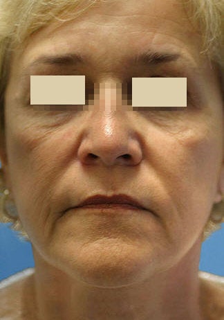 Artefill for NasoLabial Folds before 109217