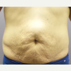 18-24 year old woman treated with Tummy Tuck before 3590096