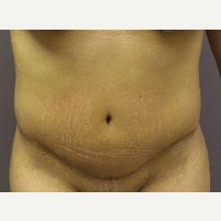 18-24 year old woman treated with Tummy Tuck after 3590096