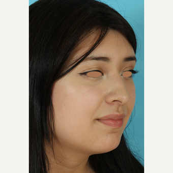 25-34 year old woman treated with Rhinoplasty before 3691285
