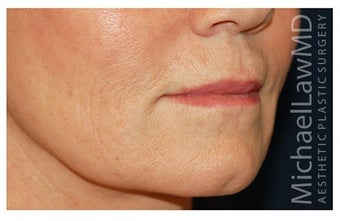 Cheek Augmentation after 1324971