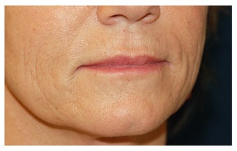 Cheek Augmentation before 1324971