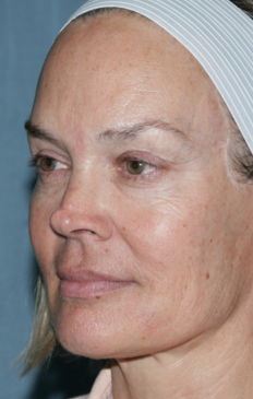 Female Patient Treated with Fraxel Repair before 1064630