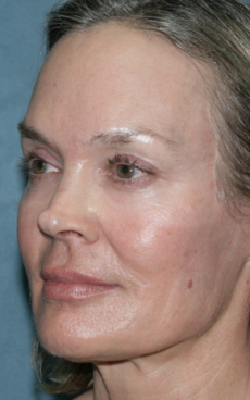 Female Patient Treated with Fraxel Repair after 1064630