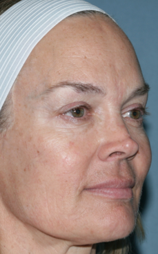 Female Patient Treated with Fraxel Repair 1064630