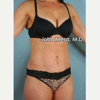 Panniculectomy after 1681856