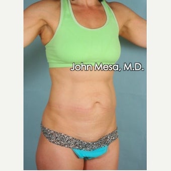 Panniculectomy before 1681856