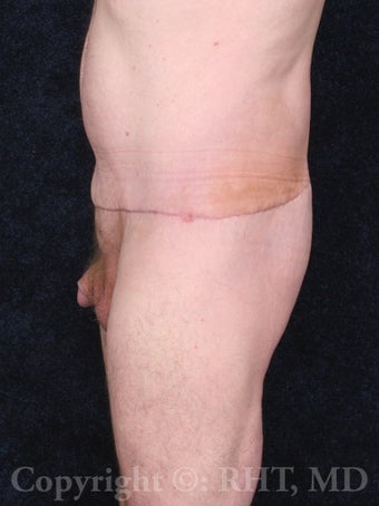62 yo man with beltlift (lower body lift) after 110+ lb weight loss. 1169145