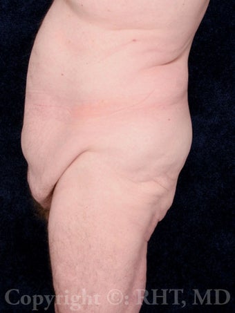 62 yo man with beltlift (lower body lift) after 110+ lb weight loss. 1169145