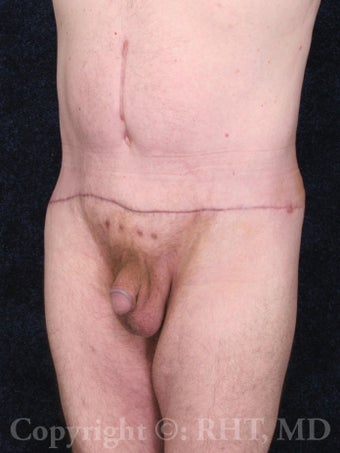 62 yo man with beltlift (lower body lift) after 110+ lb weight loss. after 1169145