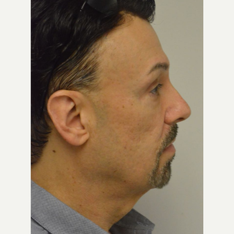 55-64 year old man treated with Perlane after 3042463