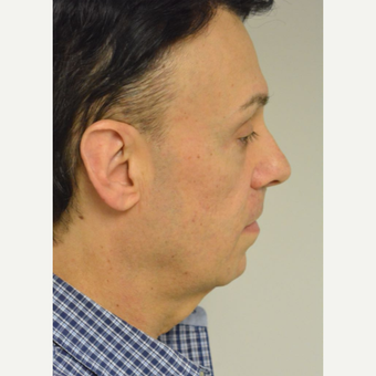 55-64 year old man treated with Perlane before 3042463