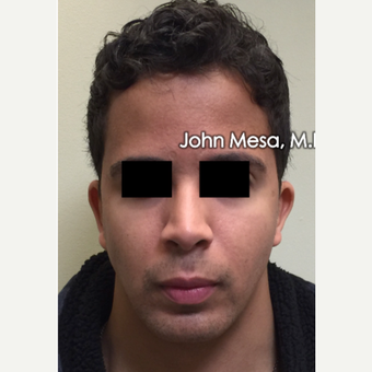 18-24 year old treated with Buccal Fat Removal after 3266812