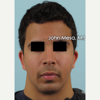 18-24 year old treated with Buccal Fat Removal before 3266812