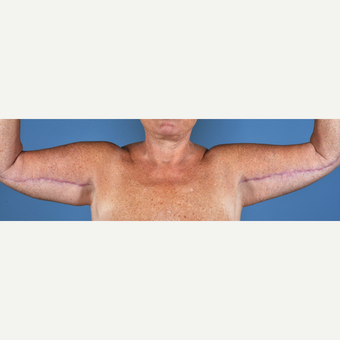 55-64 year old woman treated with Arm Lift after 3837599
