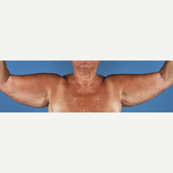 55-64 year old woman treated with Arm Lift before 3837599