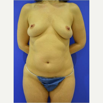 45-54 year old woman treated with Breast Reconstruction before 3744684
