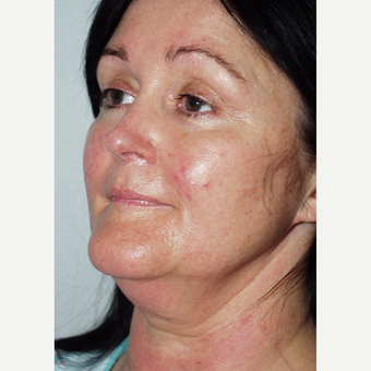48 year old woman undergoes facelift before 3440041