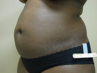 Tummy Tuck before 1160739