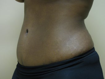 Tummy Tuck after 1160739