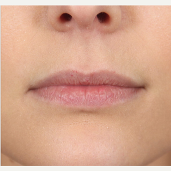 25-34 year old female treated with Juvederm to augment her lips before 2866154