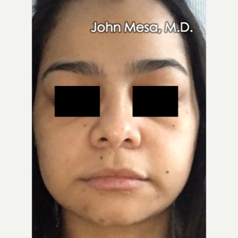18-24 year old woman treated with Buccal Fat Removal before 3266746