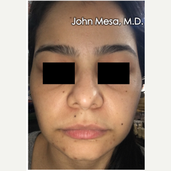 18-24 year old woman treated with Buccal Fat Removal after 3266746