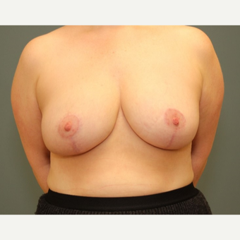 35-44 year old woman requesting a Breast Reduction after 3084472
