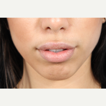 18-24 year old woman treated with Lip Augmentation after 3850906