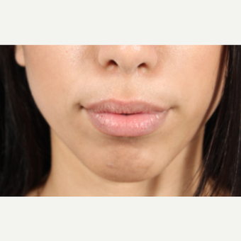 18-24 year old woman treated with Lip Augmentation before 3850906