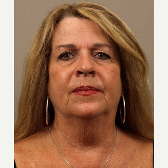 55-64 year old woman treated with Facelift before 3010005