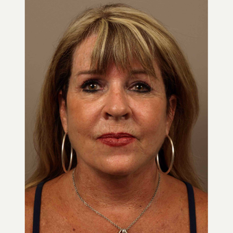 55-64 year old woman treated with Facelift after 3010005