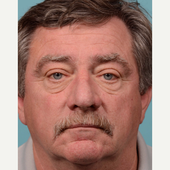 55-64 year old man treated with rhinophyma after 3064784
