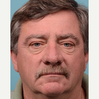 55-64 year old man treated with rhinophyma before 3064784
