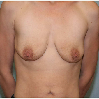 25-34 year old woman treated with Breast Lift with Implants before 3486914