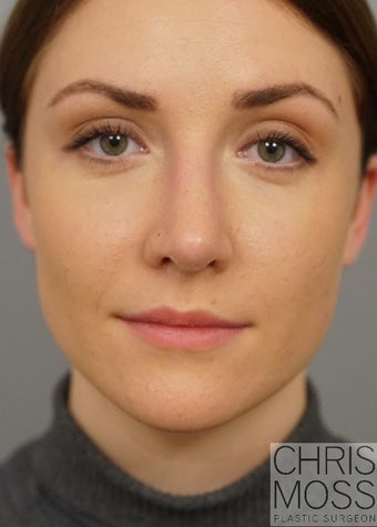Rhinoplasty performed on 23 year old woman to reduce bump after 2856153