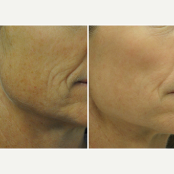 45-54 year old woman treated with Laser Resurfacing before 3776824