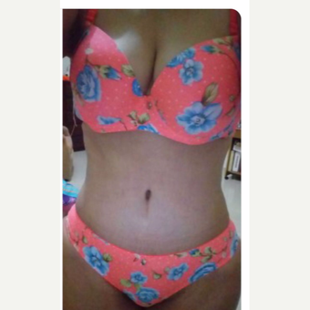 35-44 year old woman treated with Tummy Tuck after 3706804