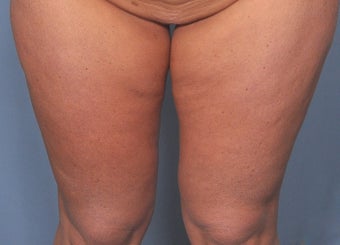 35 Year Old Female Treated For Abdominal and Thigh Skin Excess before 920529