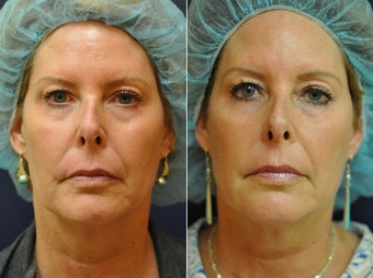 56 Year Old Female Before/After Ultherapy Full Face before 1053225